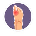Foot joint injury toe pain arthritis or skeletone damage Royalty Free Stock Photo