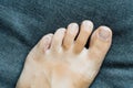 Foot little finger injury. Little toe pain and bruise after home accident. Phalange fracture. Barefoot fingernails Royalty Free Stock Photo