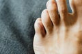 Foot little finger injury. Little toe pain and bruise after home accident. Phalange fracture. Barefoot fingernails Royalty Free Stock Photo