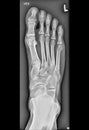 Foot medical xray, lower limb bones