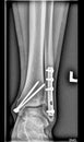 Foot medical xray, lower limb bones, broken ankle, tibia fibula with screws Royalty Free Stock Photo