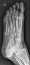 Foot Medical Xray