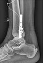 Foot Medical Xray