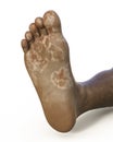 The foot with mycosis, bottom view, 3d illustration