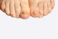 Foot nail fungus - a comparison of healthy and sore feet. Dermatomicosis and onyhomicosis, fungal infection macro photo with place Royalty Free Stock Photo