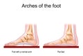 Foot with a normal arch and Flat feet