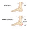 Foot with normal heel and foot with Haglund\'s deformity and bursitis.