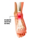 Foot pain, plantar fasciitis inflammation and ruptures strain bottom view. Realistic anatomy illustration