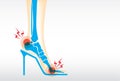 Foot pain by wearing high heels.