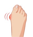 Foot with a painful bunion