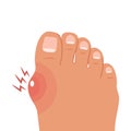 Foot with painful bunion. Healthy and sick feet. Medicine. Illustration.