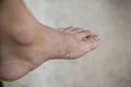 Foot of pateint skin dermatitis