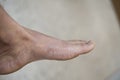 Foot of pateint skin dermatitis
