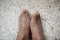 Foot of pateint skin dermatitis
