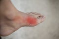 Foot of pateint skin joint arthritis