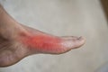 Foot of pateint skin joint arthritis Royalty Free Stock Photo