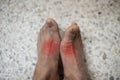 Foot of pateint skin joint arthritis Royalty Free Stock Photo