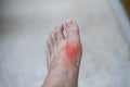 Foot of pateint skin joint arthritis