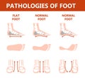 Foot pathologies infographic. Flat foot anatomy. Deformed