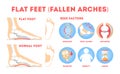 Foot pathologies infographic. Flat foot anatomy. Deformed