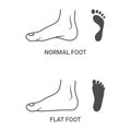 Foot Pathologies, Normal, Flat Foot Isolated On A White Background. Vector Illustration.