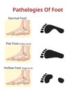 Foot pathologies, Normal, flat and hollow foot - Vector Illustration Royalty Free Stock Photo