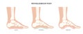 Foot pathologies poster Royalty Free Stock Photo