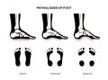 Foot pathologies poster