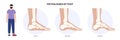 Foot pathologies poster Royalty Free Stock Photo