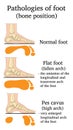 Foot pathology illustration