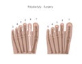 Foot polydactyly. Surgical elimination of extra toe, medical chart. Royalty Free Stock Photo