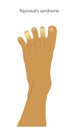 A foot with Raynaud's syndrome symptoms on tips of the toes. Peripheral cyanosis shown as white and discoloured toes