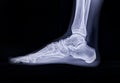 foot scan, film foot, foot pain, anatomy, ankle, arthritis, body, bone, bottom, broken, care, clinic, deformity, diagnosis,