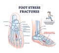 Foot stress fractures as bone cracking trauma or injury outline diagram Royalty Free Stock Photo