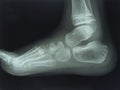 Foot and Toes. Human Leg in the X-ray image Royalty Free Stock Photo