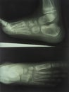 Foot and Toes. Human Leg in the X-ray image Royalty Free Stock Photo