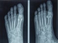 Foot and Toes. Human Leg in the X-ray image Royalty Free Stock Photo