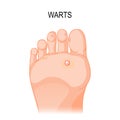 Foot wart