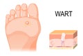 Foot warts on the bottom of soles and toes. Cross section of a c Royalty Free Stock Photo