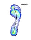 Foot weight distribution. Normal arch foot bottom thermal view. No deformation.