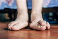 Foot which have bunion hallux valgus problem on floor