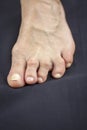 Foot Of Woman Deformed From Rheumatoid Arthritis