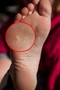 A Foot a woman finger with blisters