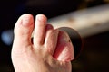 A Foot a woman finger with blisters