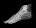 Foot X-ray Royalty Free Stock Photo