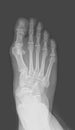 Foot x-ray Royalty Free Stock Photo