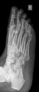 Foot x-ray image oblique view