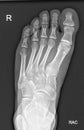 Foot X-Ray Royalty Free Stock Photo