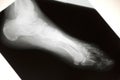 Foot Xray Royalty Free Stock Photo