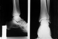 Foot xray Royalty Free Stock Photo
